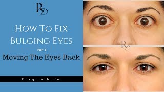 How To Fix Bulging Eyes  Part 1  Moving The Eyes Back [upl. by Kellyn]