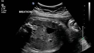 fetal breathing ultrasound [upl. by Paulsen]