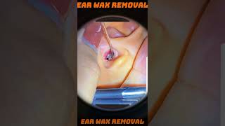 Ear Wax Removal 27 ears earwaxremoval asmr satisfying [upl. by Giana836]