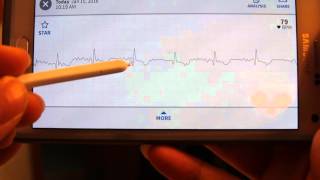 AliveCor Mobile ECGEKG accuracy test review [upl. by Enaej456]