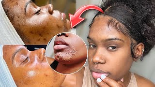 My Chemical Peel Transformation  Part 1 [upl. by Yecaj]