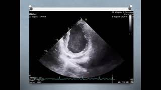 Assessment of Mitral paravalvular leak [upl. by Elfreda598]