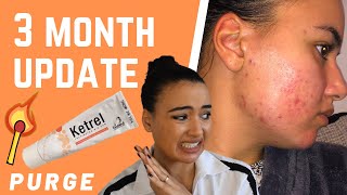 MY SKIN IS WORSE 😩 TRETINOIN CREAM PURGE  3 MONTH UPDATE [upl. by Cenac876]