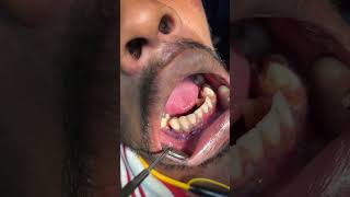 Mandible parasymphyseal fracture surgical outcome l07044611705 l Dr Arindam MandalOmfsjawfracture [upl. by Bremble]