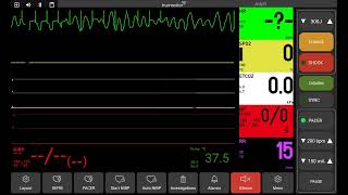 Pulseless Electrical Activity PEA [upl. by Eydnarb]