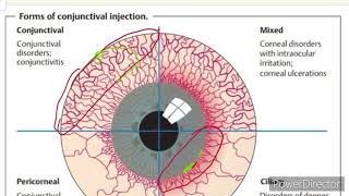 Conjunctiva  Red eye  Conjunctival and Ciliary Congestion  Ophthalmology [upl. by Nho]