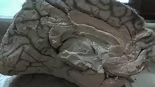 Medial surface of cerebrum real viscera [upl. by Ahsenak]