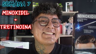 Minoxidil y Tretinoina te da mejores resultados   Semana 7 [upl. by Anaitsirc]