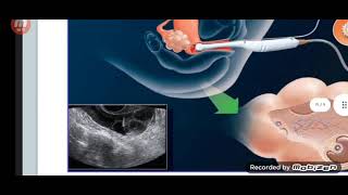 assisted reproductive  partograph [upl. by Aerona]