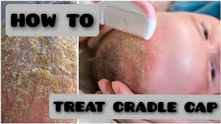 How to Treat Cradle CapNewborn baby newborn cradlecap [upl. by Macpherson3]