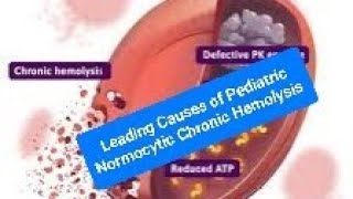 Leading Causes of Pediatric Normocytic Chronic Hemolysis G6PD and PKD [upl. by Aenej]