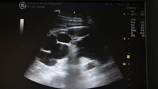 Ultrasound of spermatocele [upl. by Yadnil]