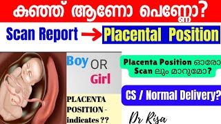 Gender Prediction Malayalam Anterior Placental Boy Girl കുഞ്ഞ് ആണോ പെണ്ണോ [upl. by Cleary]