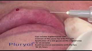 Pluryal® Lips Augmentation [upl. by Uzzi]