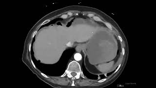 Gastric pylorus peptic ulcer perforation CT [upl. by Steddman665]