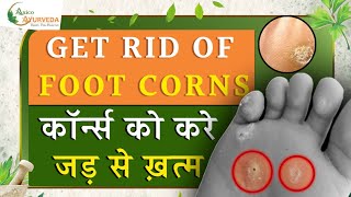 GET RID OF FOOT CORNS कॉर्न्स को करें जड़ से खत्म Axico Ayurveda [upl. by Notsahc]