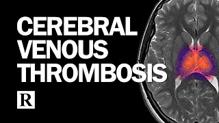 Diagnosis and Management of Cerebral Venous Thrombosis [upl. by Noslrac205]