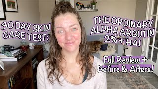 30 DAY SKIN CARE TEST THE ORDINARY ALPHA ARBUTIN 2  HA Full Review  Before amp Afters [upl. by Ylhsa]