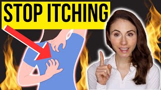 HOW TO STOP ITCHING ON THE BACK  Notalgia Paresthetica [upl. by Ahseka]