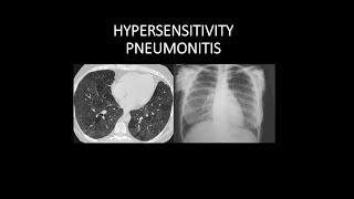 HYPERSENSITIVITY PNEUMONITIS  CLINICORADIOLOGICAL VIDEO SERIES CHEST [upl. by Aihtnis]