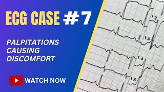 ECG Case 7 Palpitations causing discomfort  Identify Origin [upl. by Bryana323]