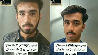 برص Vitiligo  2 ماہ علاج سے پہلے اور 2 ماہ علاج کے بعد ریزلٹ [upl. by Nadabus]