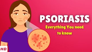 Psoriasis – Causes Types Signs and Symptoms Diagnosis amp Treatment [upl. by Nnaeiram]