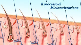 Alopecia Androgenetica il processo di Miniaturizzazione [upl. by Randy160]