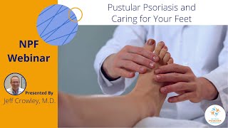 Pustular Psoriasis and Caring for Your Feet [upl. by Ferriter77]