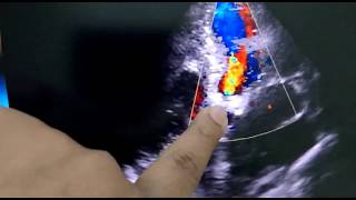 severe aortic stenosis on apical view note no color flow across the finger [upl. by Munroe]