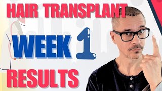 Cosmedica Hair Transplant  1 Week After Results [upl. by Domenic]