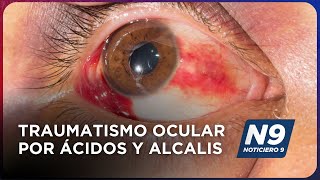 TRAUMATISMO OCULAR POR ÁCIDOS Y ÁLCALIS  NOTICIERO 9 [upl. by Gridley250]