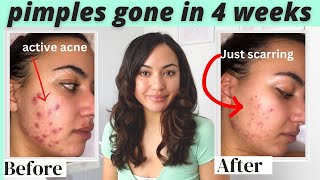 How to get clear skin in 1 month  Antibiotics for Acne  Differin results adapalene  DOXYCYCLINE [upl. by Ssidnak]