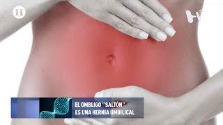 HERNIA INGUINAL  Qué es qué afecta síntomas  causas y tratamiento fisioterapéutico [upl. by Ami]