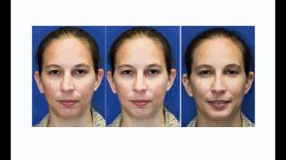 Before amp After Seattle Rhinoplasty Nose job  Crooked Nose and Chin Augmentation [upl. by Noelc]