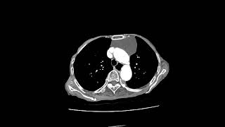 thymic cyst [upl. by Ahusoj]