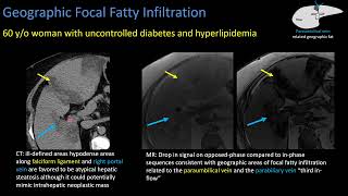 Hepatic Steatosis Part 2 Patterns of Steatosis [upl. by Yddor]