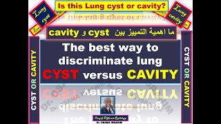 The best way to discriminate cystic lung lesion versus cavity and its impartance [upl. by Cirone]