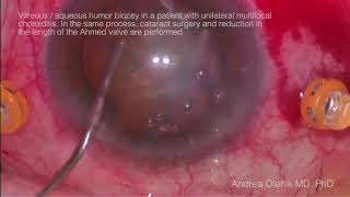 Vitreous aqueous humor biopsy in a patient with unilateral multifocal choroiditis In the same pro [upl. by Ysnil318]