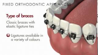 MalocclusionFixed Orthodontic AppliancesBraces [upl. by Kylstra811]