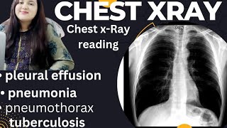 Chest XRay  XRay reading CP Angle  chest thoracic ratio broncho vascular measurement Hindi [upl. by Normandy]