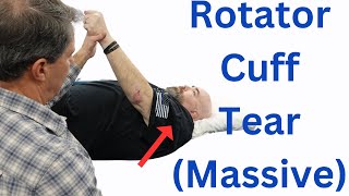 Massive Rotator Cuff Tear Classic signs [upl. by Cis254]