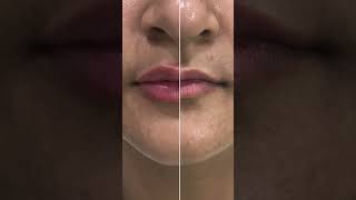 💋✨ Lip fillers skincare dermatologist skincareroutine [upl. by Arraeic]