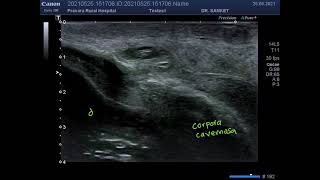 Penile Fracture Ultrasonography [upl. by Kavita]