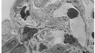 Understanding Membranoproliferative Glomerulonephritis Part 1 Hot Topic [upl. by Buhler]