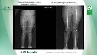 Tratamento precoce e tardio da doença de blount  Dr David Gonçalves Nordonb [upl. by Ardekahs]