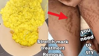 Stretch mark treatmentRemove your stretch mark in just 3 Days with this remedy oil amp soap [upl. by Garson635]