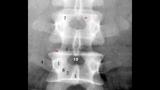 Radiological Anatomy of the Lumbar Spine Xray MRI amp CT Covered [upl. by Lenrad]