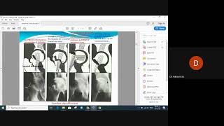 orthopedicproximal femoral neck fractureكسور [upl. by Bonneau]