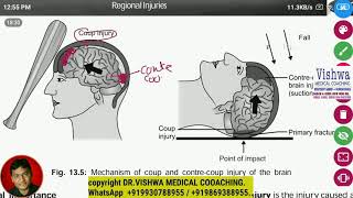 mechanism of coup conte coup brain injury BY DRVISHWA MEDICAL COACHING WHATSAPP 919930788955 [upl. by Adliwa571]